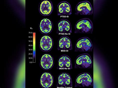 Depression Brain Scan