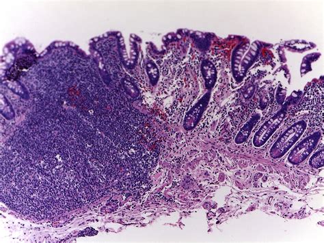 GASTROINTESTINAL AND LIVER HISTOLOGY PATHOLOGY ATLAS: COLON LYMPHOID POLYP