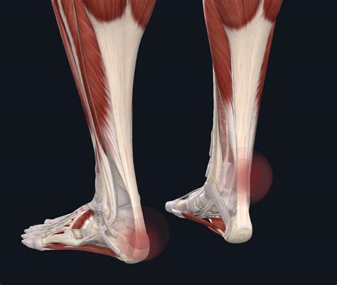 What Is Achilles Tendinopathy? | The Physios