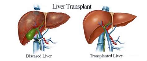 Liver transplantation