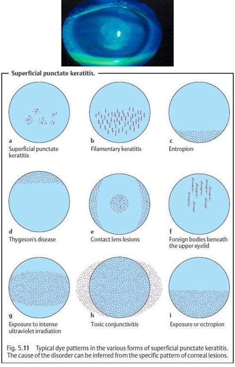 Superficial Punctate Keratitis - Eye Disorders - StudyPK