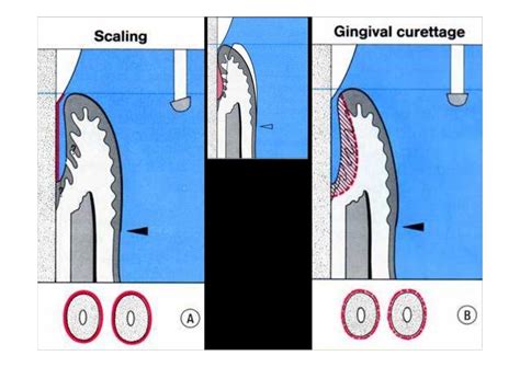 Modified widman flap