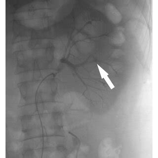 (a) An arcuate artery was ruptured (white arrow). (b) The arrow shows ...