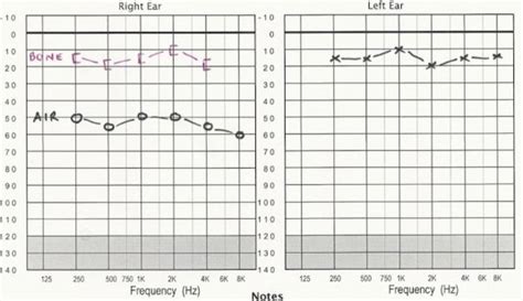 Types of Deafness - Ears & Hearing UK