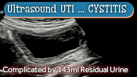 Cystitis ( UTI ) Ultrasound | Diagnosis - YouTube