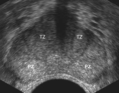 FIGURE 30-2 Normal prostate, transverse plane. TZ, Transitional zone; PZ, peripheral zone ...