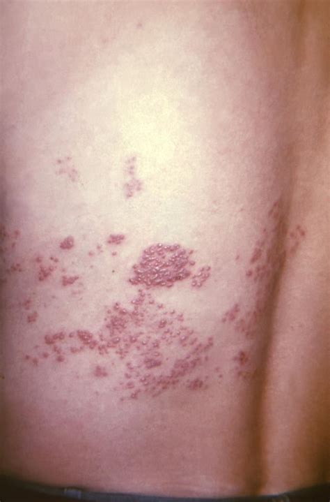 Herpes Zoster (Shingles) | Concise Medical Knowledge