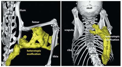 New hope for rare 'stone man' disease, where flesh turns to bone