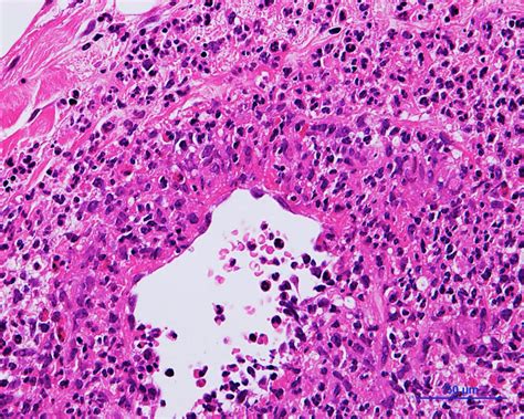 Polyangiitis overlap syndrome of granulomatosis with polyangiitis (Wegener's granulomatosis) and ...