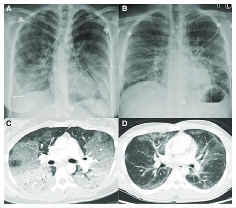 Chest radiograph and CT angiogram obtained from two patients with... | Download Scientific Diagram