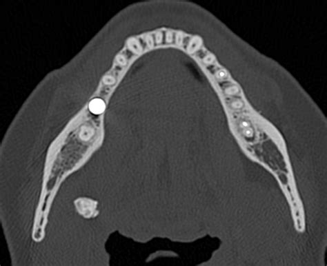 Sialolithiasis | Image | Radiopaedia.org