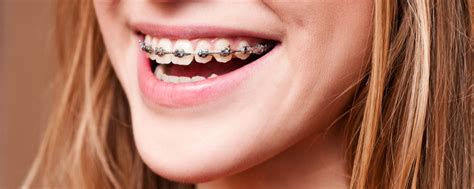 Metal Braces | Rollins & Petersen Orthodontics Gilbert, AZ,