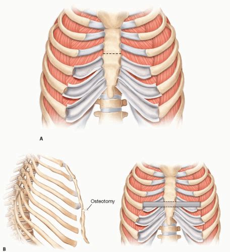 Juvenile Hypertrophy | Plastic Surgery Key