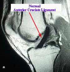 What is an ACL