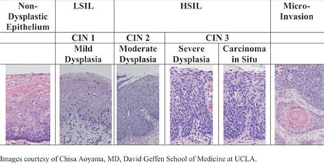 Pin em "Cervical intraepithelial neoplasia"