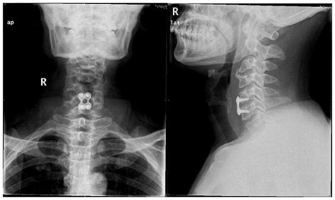 Cervical Spondylosis X Ray / Treatment for Cervical Spondylosis : Cervical spondylosis ...