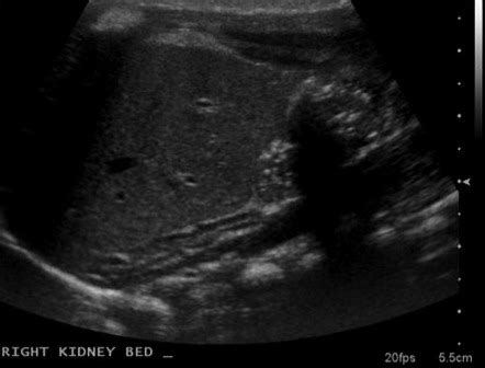 The Normal Adrenal Glands on Ultrasound Are Best Described as