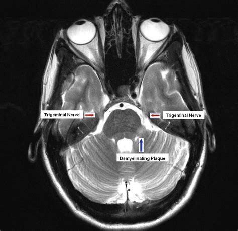 Trigeminal Nerve Mri Brain