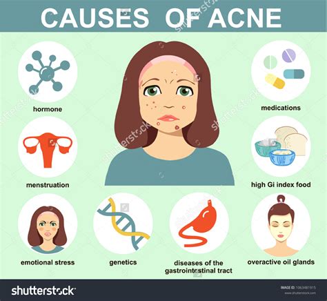 Acne Causes