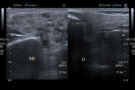 Mumps | Radiology Reference Article | Radiopaedia.org