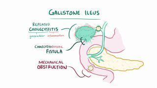 Ileus: What Is It, Types, Causes, Diagnosis, Treatment, and More | Osmosis