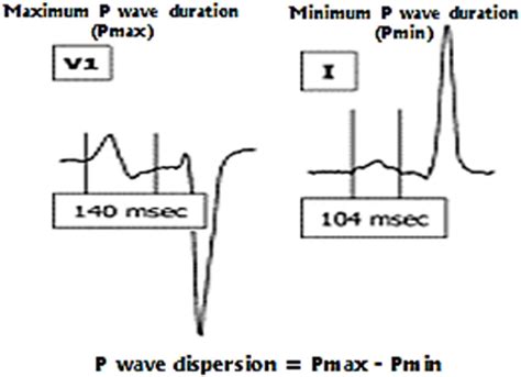 P wave dispersion calculation. | Download Scientific Diagram