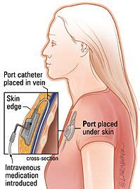 port-cath - Ask.com Image Search | Autoimmune disease, Port, Gastroparesis