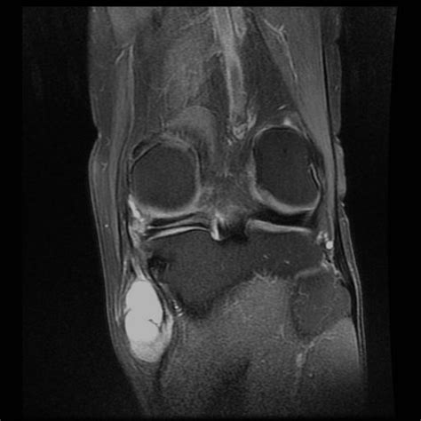 Pes anserinus bursitis. Source: CKC UK. www.kneeclinic.info | Pes anserinus, Bursitis