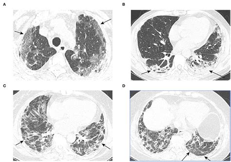 Frontiers | A New Predictive Model for the Prognosis of MDA5+ DM-ILD