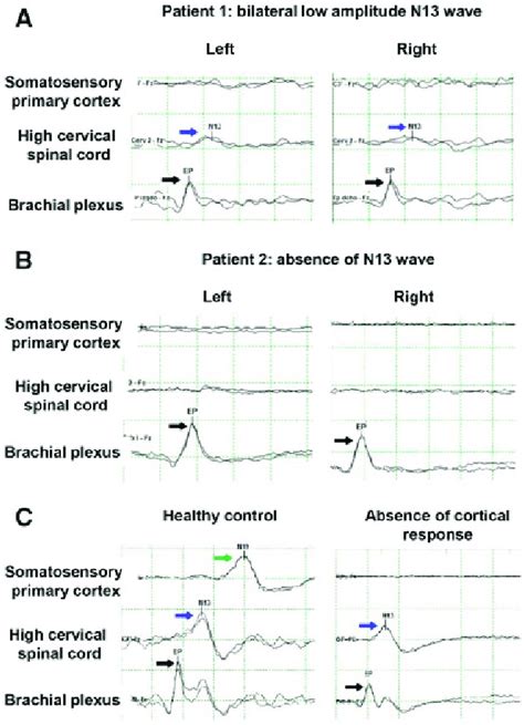 Somatosensory evoked potentials of the median nerve. The evoked... | Download Scientific Diagram