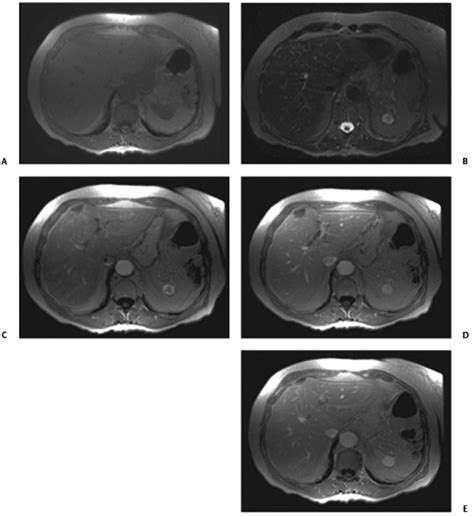 42 Hemangioma of the Spleen | Radiology Key