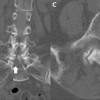 CT-myelogram of the lumbar spine showing a right intra-canalar,... | Download Scientific Diagram