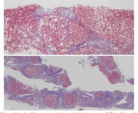 Histology Of Normal Liver Fibrosis And Cirrhosis A Representative Images