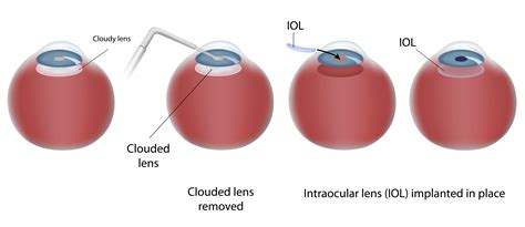 Cataract Surgery