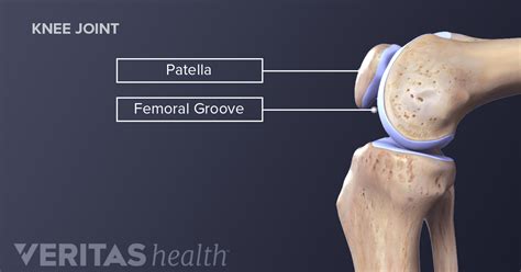 Symptoms of Kneecap Dislocation