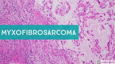 Myxofibrosarcoma 101...Explained by a Sarcoma Pathologist - YouTube