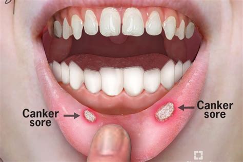 MOUTH ULCERS (CANKER SORES) | HealthGist.Net