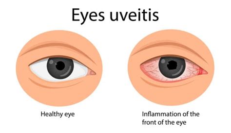 Uveitis Guide: Types, Symptoms, Causes, and Treatments | MyVision.org (2022)