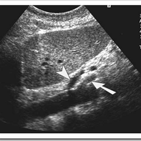 Ultrasound images normal anatomy abdominal aorta - Radiology Imaging