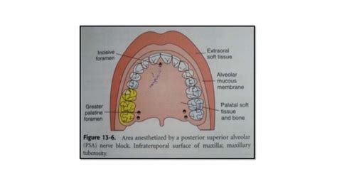 Palatine Nerve Block