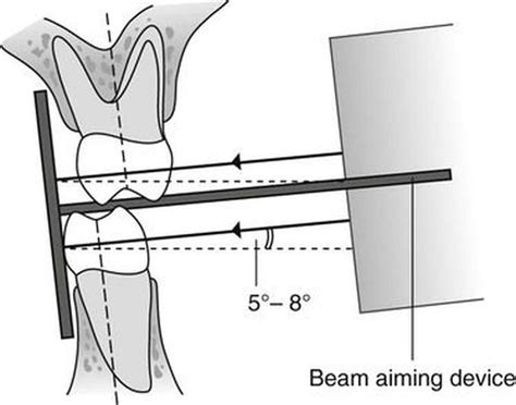 Bitewing radiograph technique - MEDizzy