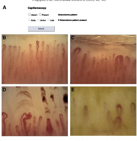 Figure 1 from Nailfold capillaroscopy in systemic sclerosis: data from the EULAR scleroderma ...