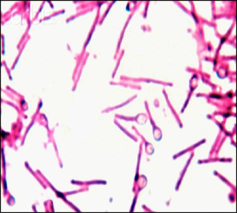 Terminal bulging spores of Clostridium tetani | Medical Laboratories