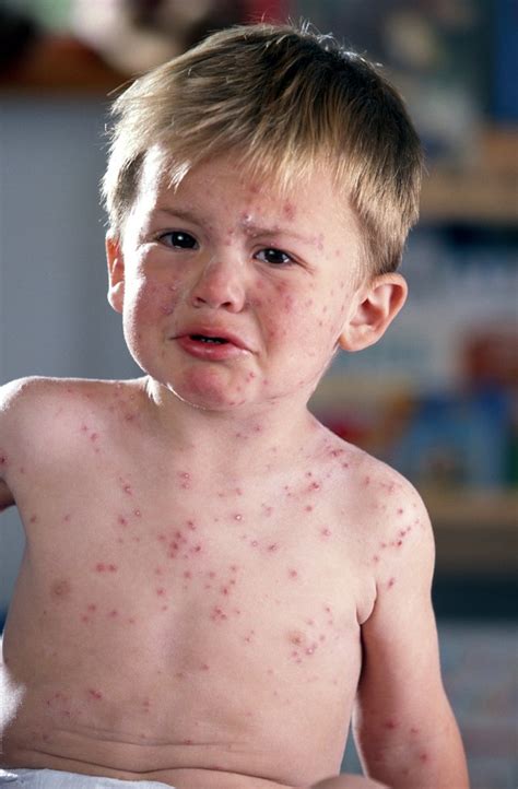 Coughing With a Rash in Children | Livestrong.com