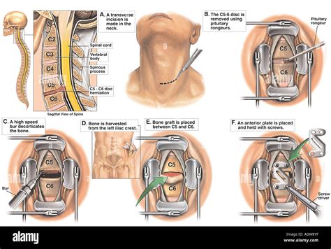 Anterior Cervical Spinal Fusion Surgery