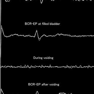 The bulbocavernosus reflex (BCR) during the micturition cycle. The... | Download Scientific Diagram