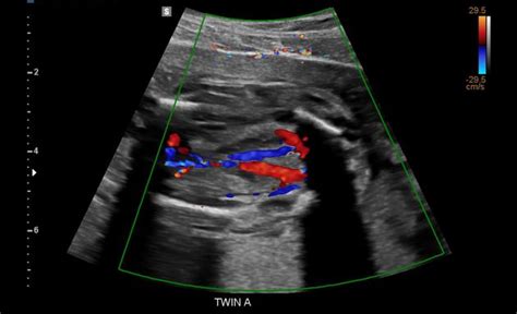 Renal Bilateral Ultrasound