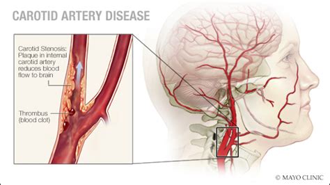 Carotid Disease Treatment | Carotid Artery Blockage Surgery