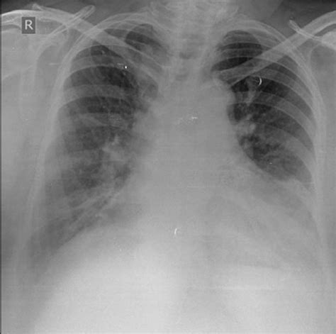 Chest X-ray showing left lower lobe consolidation with minimal pleural ...