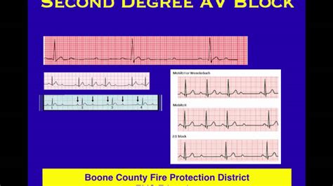 ECG 11 Skipped Beats - YouTube